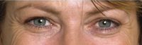 Botox correctong Crow´s Feet